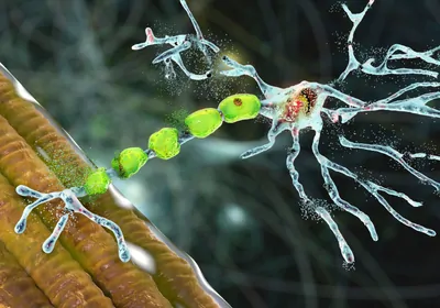 A conceptual 3D illustration of motor neurons degrading